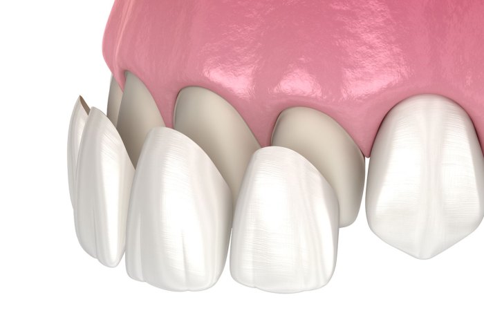 Tooth bonding near me