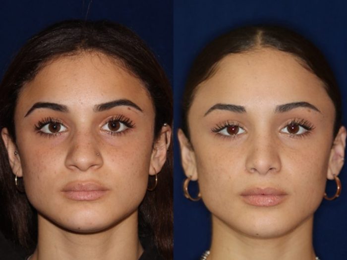 Ethnic nose jobs