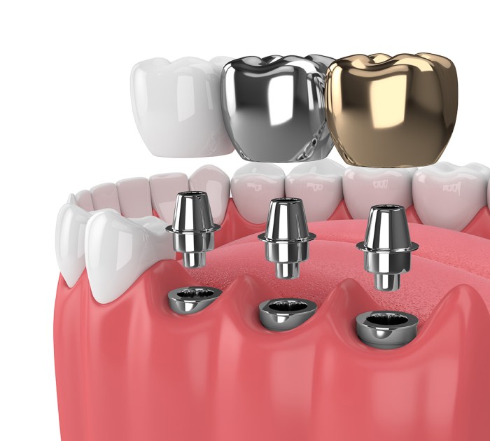 Best dental implants brand