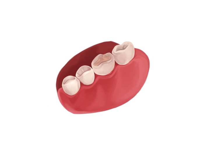 How much is a cavity filling without insurance