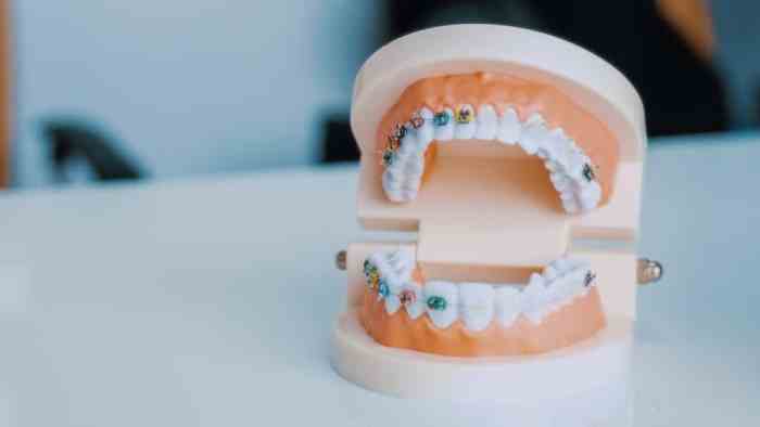 Braces take invisalign orthodontist tightening How long does it take to put on braces