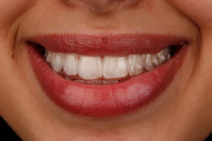 How to get invisalign