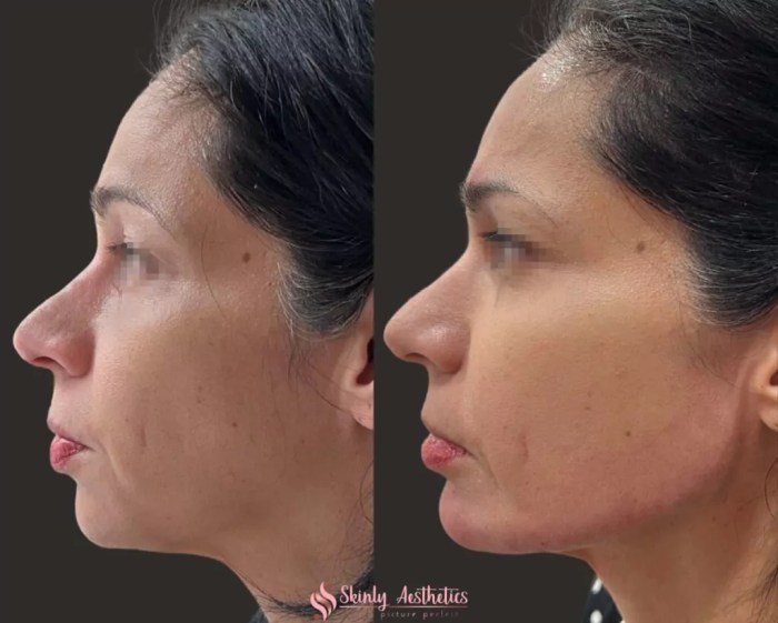 How much is chin filler