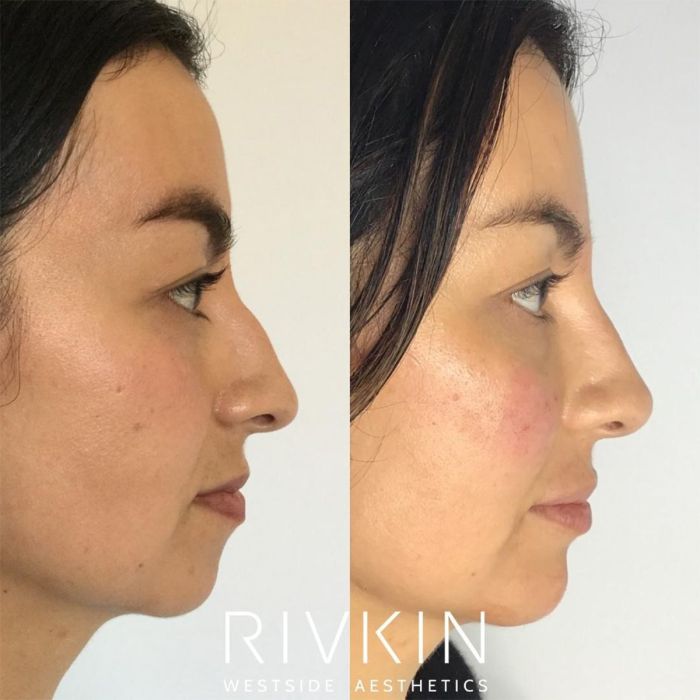 Non surgical nose job near me