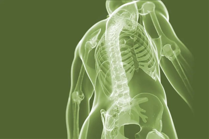Can spinal stenosis be caused by a car accident